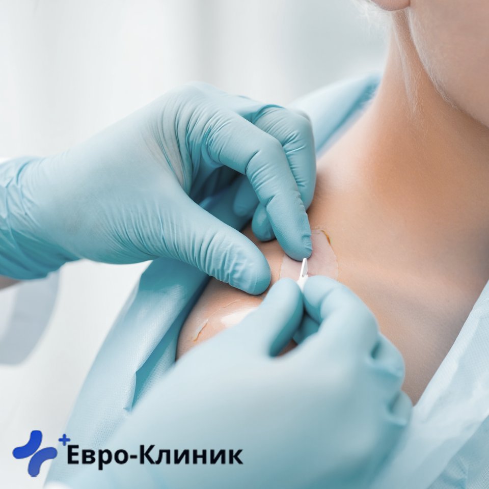 Процедура химзащиты (вшивание) от алкоголизма